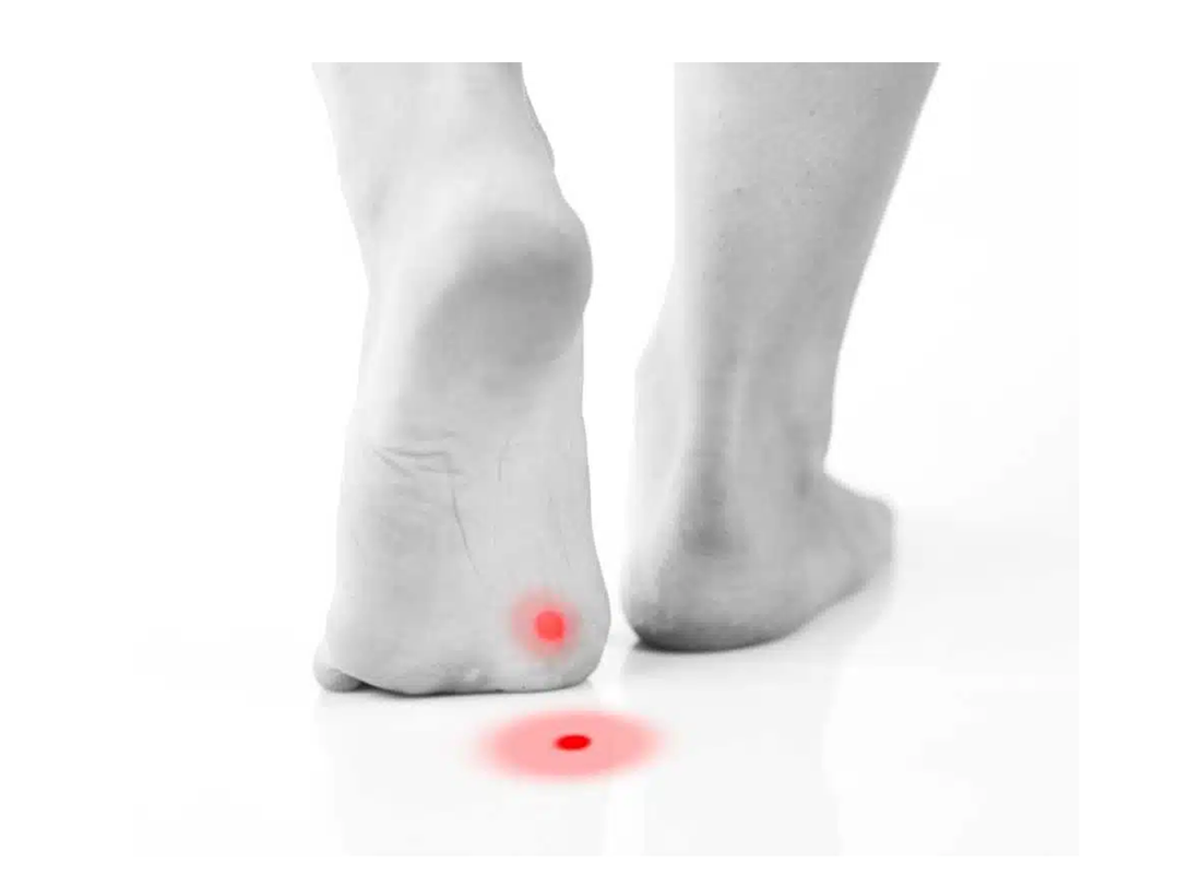 Best Effective Verruca and Wart Treatment